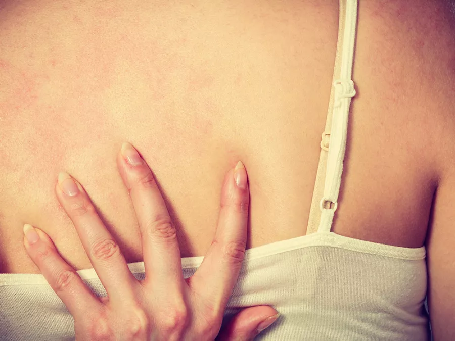 L’orticaria