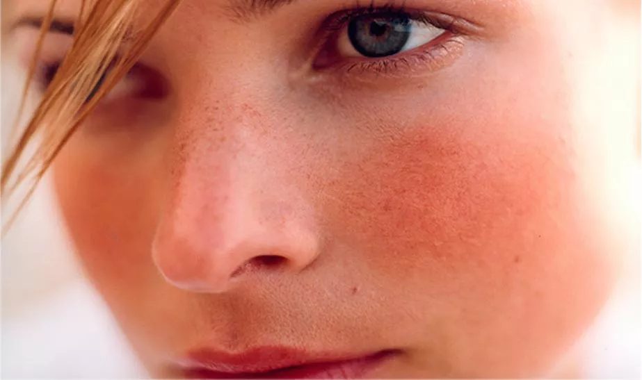 La rosacea: conoscerla e curarla