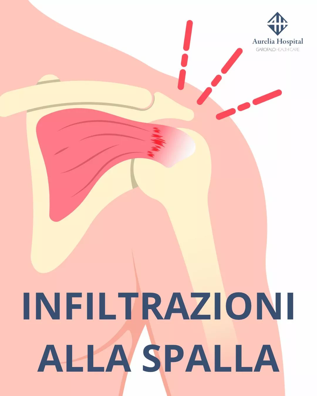 Infiltrazioni alla spalla 
